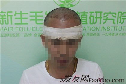 杭州新生植發(fā)2800單位，自信的魅力重新歸來