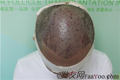 杭州新生植發(fā)2800單位，自信的魅力重新歸來