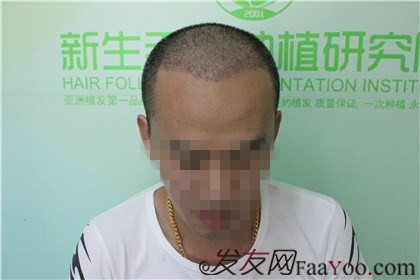 杭州新生植發(fā)2800單位，自信的魅力重新歸來