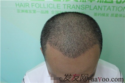 杭州新生植發(fā)2800單位，自信的魅力重新歸來