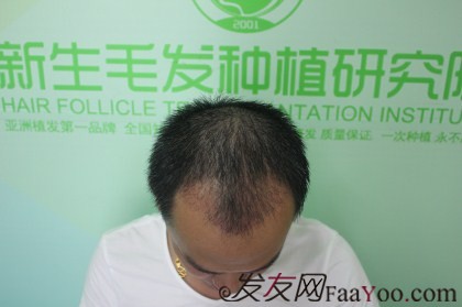 杭州新生植發(fā)2800單位，自信的魅力重新歸來