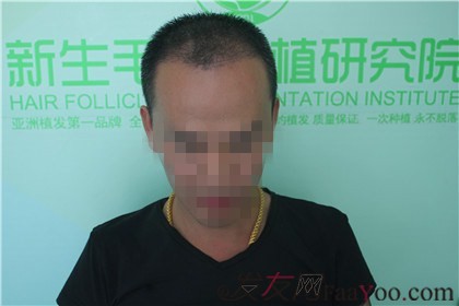 杭州新生植發(fā)2800單位，自信的魅力重新歸來