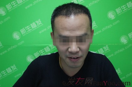 杭州新生植發(fā)2800單位，自信的魅力重新歸來