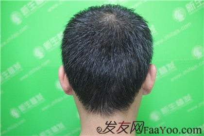 杭州新生植發(fā)2800單位，自信的魅力重新歸來