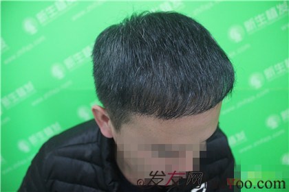 杭州新生植發(fā)2800單位，自信的魅力重新歸來