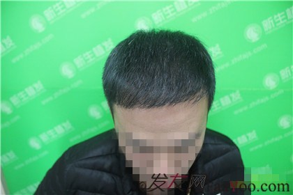 杭州新生植發(fā)2800單位，自信的魅力重新歸來