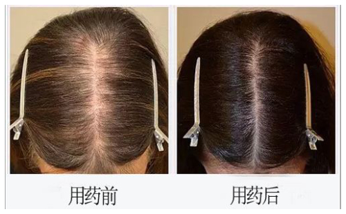 米諾地爾一年效果圖