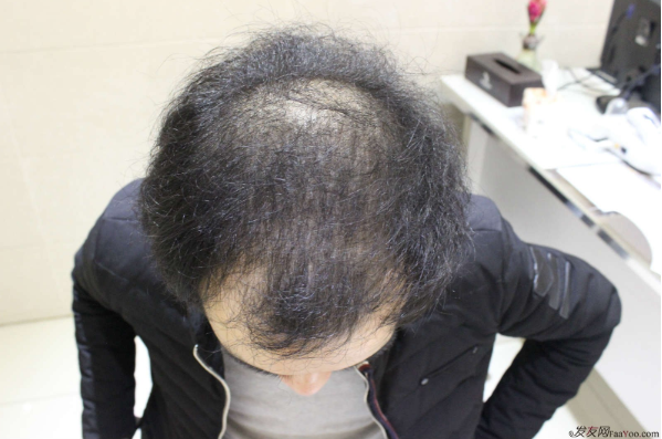 我在長(zhǎng)沙大麥微針植發(fā)3100單位，術(shù)后恢復(fù)成這樣了