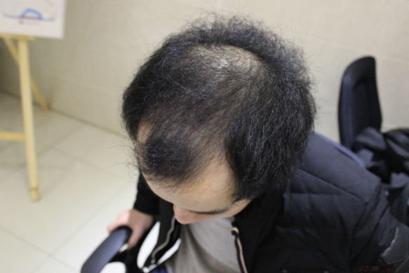 我在長(zhǎng)沙大麥微針植發(fā)3100單位，術(shù)后恢復(fù)成這樣了