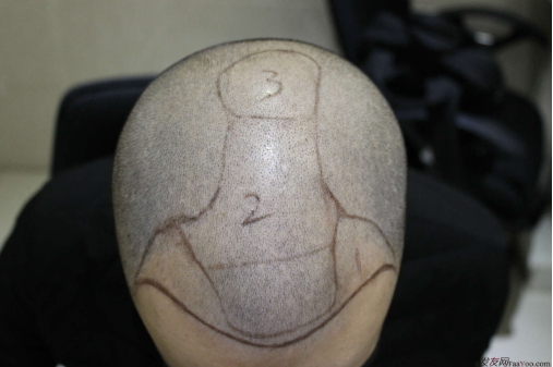 我在長(zhǎng)沙大麥微針植發(fā)3100單位，術(shù)后恢復(fù)成這樣了