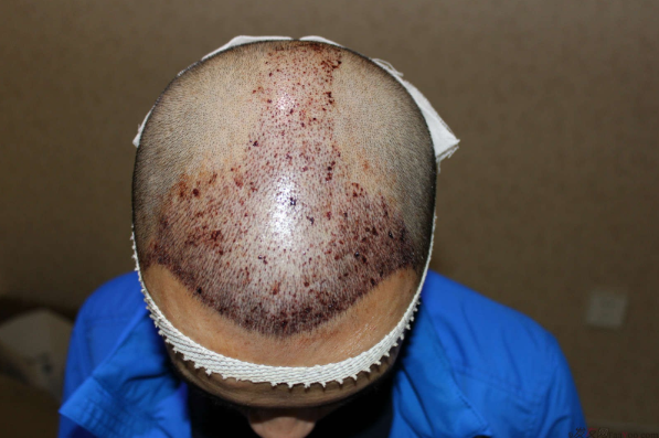 我在長(zhǎng)沙大麥微針植發(fā)3100單位，術(shù)后恢復(fù)成這樣了