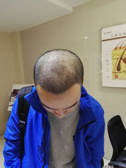 我在長(zhǎng)沙大麥微針植發(fā)3100單位，術(shù)后恢復(fù)成這樣了