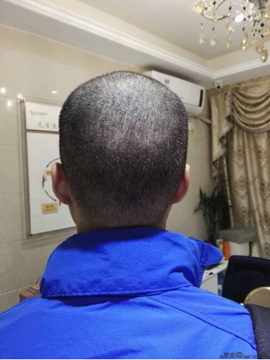 我在長(zhǎng)沙大麥微針植發(fā)3100單位，術(shù)后恢復(fù)成這樣了