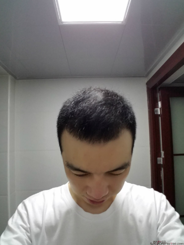 我在長(zhǎng)沙大麥微針植發(fā)3100單位，術(shù)后恢復(fù)成這樣了