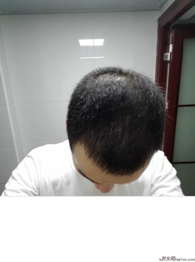 我在長(zhǎng)沙大麥微針植發(fā)3100單位，術(shù)后恢復(fù)成這樣了