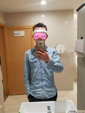 從脫發(fā)到植發(fā)的歷程，廣州大麥微針前額植發(fā)FUE2200單位