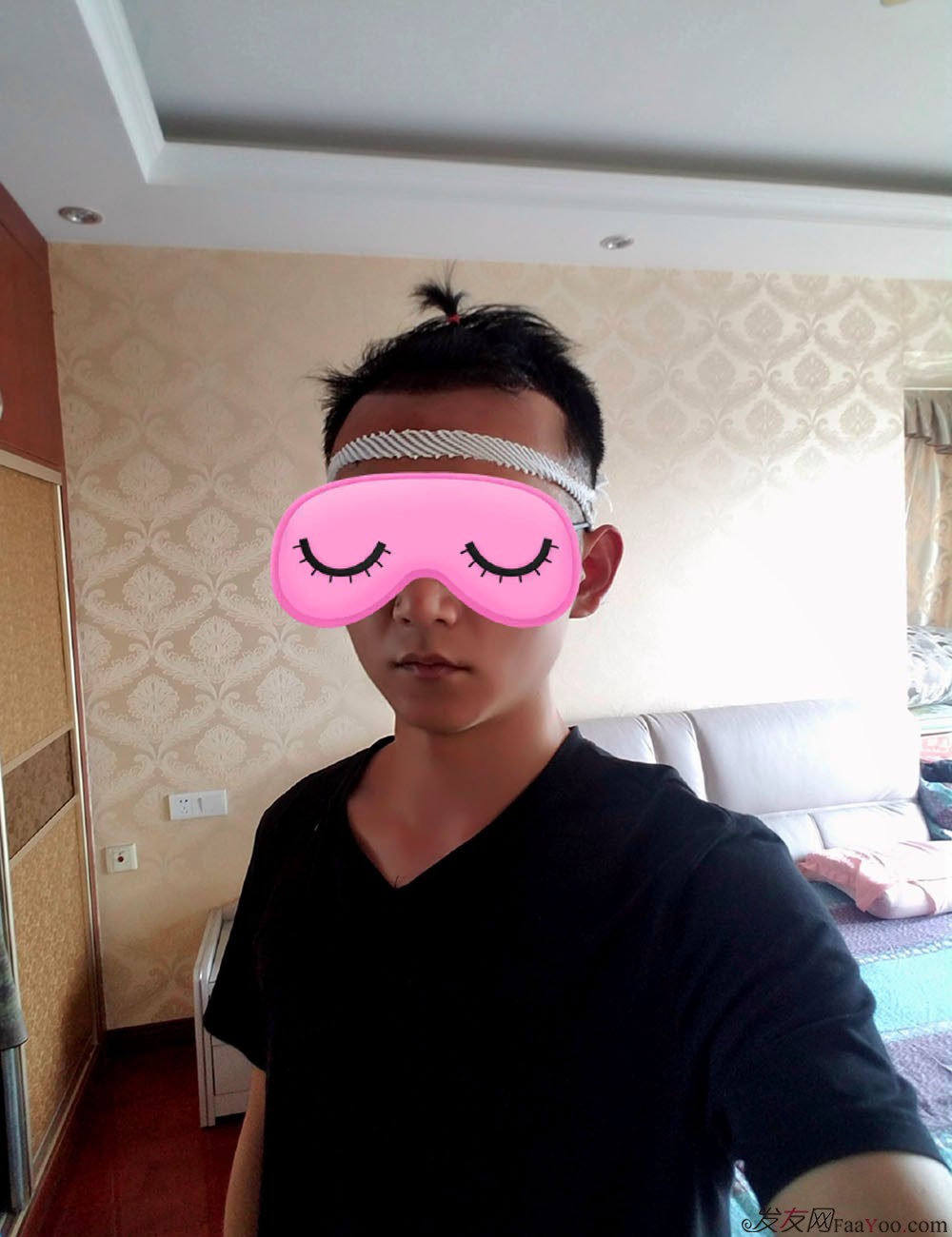 從脫發(fā)到植發(fā)的歷程，廣州大麥微針前額植發(fā)FUE2200單位