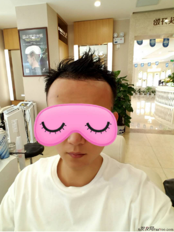 從脫發(fā)到植發(fā)的歷程，廣州大麥微針前額植發(fā)FUE2200單位