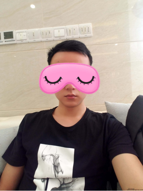 從脫發(fā)到植發(fā)的歷程，廣州大麥微針前額植發(fā)FUE2200單位