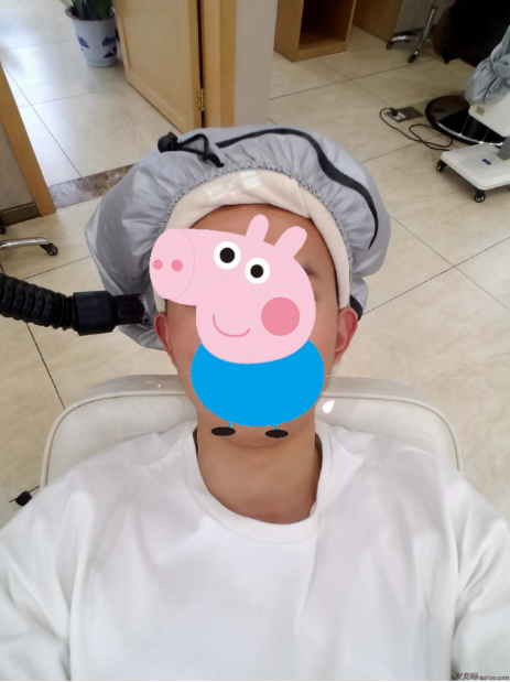 從脫發(fā)到植發(fā)的歷程，廣州大麥微針前額植發(fā)FUE2200單位