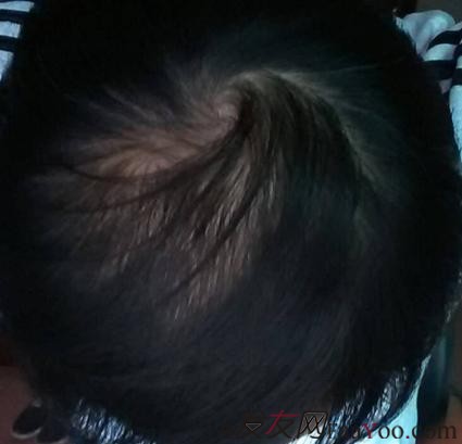 脫發(fā)八年，我植發(fā)了！3300單位 長沙大麥微針