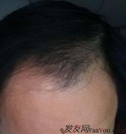 脫發(fā)八年，我植發(fā)了！3300單位 長沙大麥微針