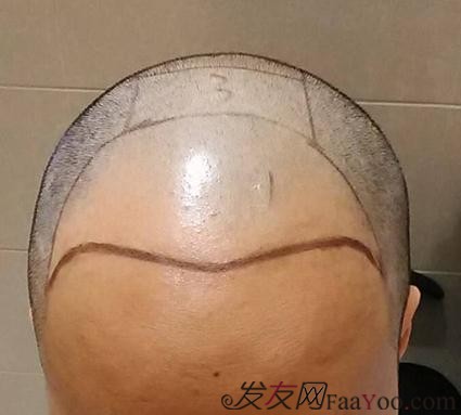 脫發(fā)八年，我植發(fā)了！3300單位 長沙大麥微針