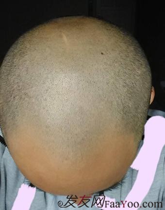 脫發(fā)八年，我植發(fā)了！3300單位 長沙大麥微針