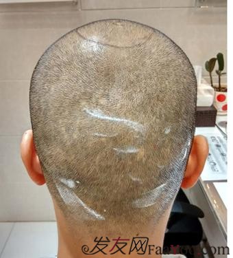 脫發(fā)八年，我植發(fā)了！3300單位 長沙大麥微針