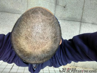 脫發(fā)八年，我植發(fā)了！3300單位 長沙大麥微針