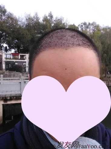 脫發(fā)八年，我植發(fā)了！3300單位 長沙大麥微針