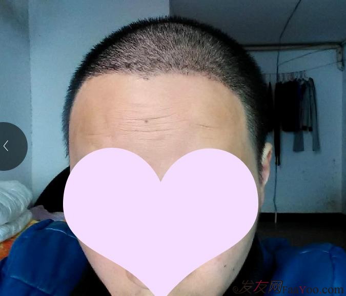 脫發(fā)八年，我植發(fā)了！3300單位 長沙大麥微針