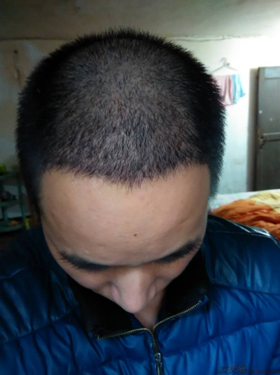 脫發(fā)八年，我植發(fā)了！3300單位 長沙大麥微針