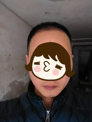 脫發(fā)八年，我植發(fā)了！3300單位 長沙大麥微針
