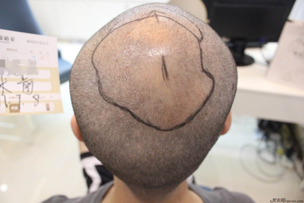 上海大麥微針2400Ptt頭頂加密.與發(fā)友們一起期待