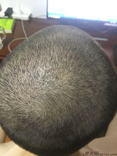 上海大麥微針2400Ptt頭頂加密.與發(fā)友們一起期待