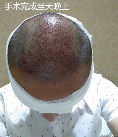 長沙大麥微針3000毛囊單位 漫漫生發(fā)路，雖難猶未悔！