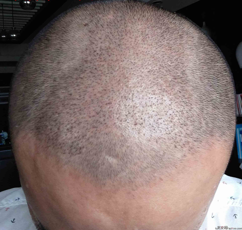 長沙大麥微針3000毛囊單位 漫漫生發(fā)路，雖難猶未悔！