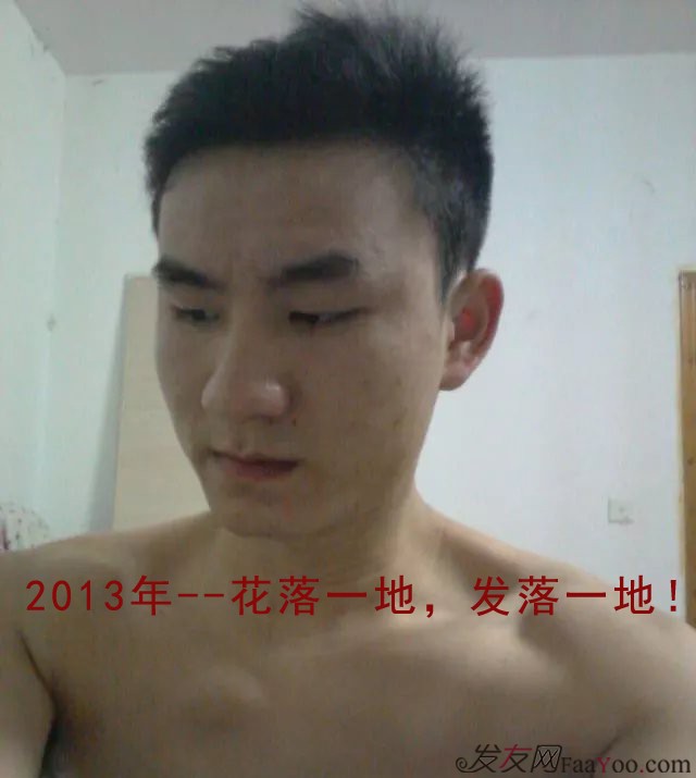 長沙大麥微針3000毛囊單位 漫漫生發(fā)路，雖難猶未悔！