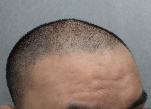 長沙大麥微針3000毛囊單位 漫漫生發(fā)路，雖難猶未悔！