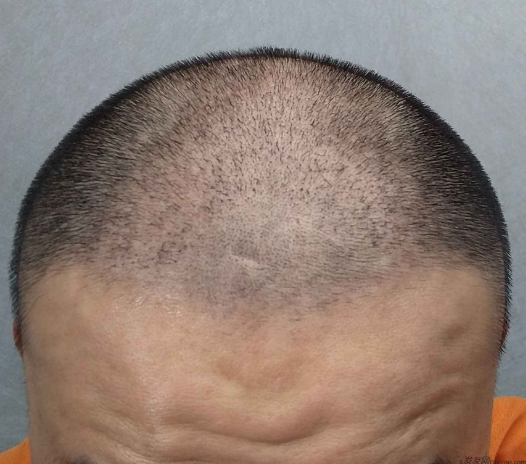 長沙大麥微針3000毛囊單位 漫漫生發(fā)路，雖難猶未悔！