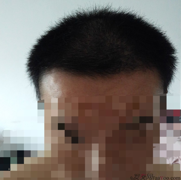 長沙大麥微針3000毛囊單位 漫漫生發(fā)路，雖難猶未悔！