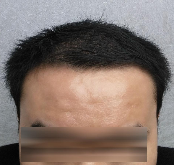 長沙大麥微針3000毛囊單位 漫漫生發(fā)路，雖難猶未悔！