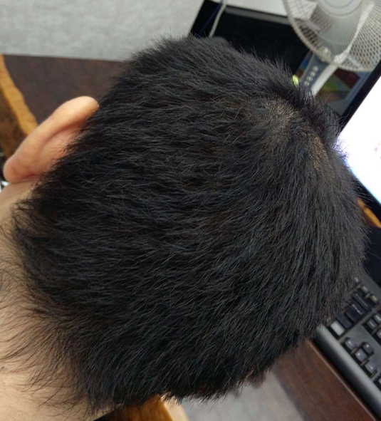 長沙大麥微針3000毛囊單位 漫漫生發(fā)路，雖難猶未悔！