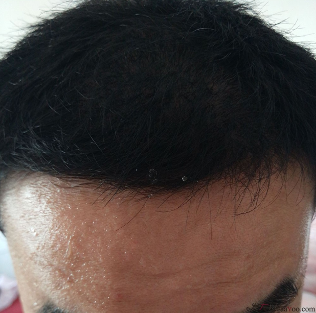 長沙大麥微針3000毛囊單位 漫漫生發(fā)路，雖難猶未悔！