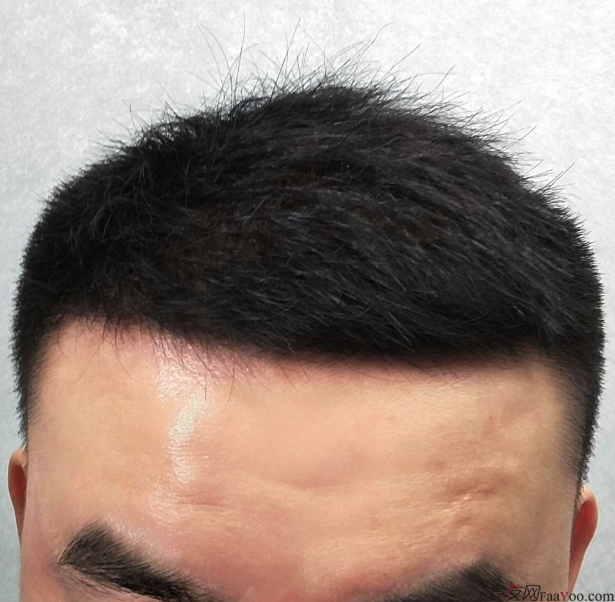 長沙大麥微針3000毛囊單位 漫漫生發(fā)路，雖難猶未悔！