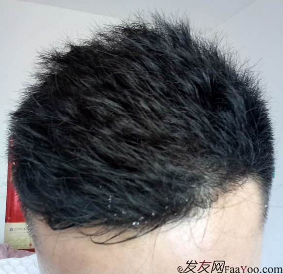 長沙大麥微針3000毛囊單位 漫漫生發(fā)路，雖難猶未悔！