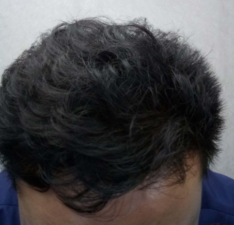 長沙大麥微針3000毛囊單位 漫漫生發(fā)路，雖難猶未悔！