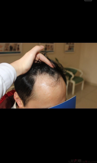 成都大麥微針醫(yī)院3400個(gè)單位，蛻變現(xiàn)在開始！