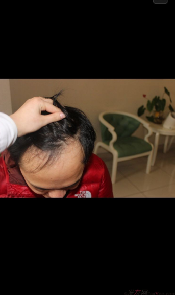 成都大麥微針醫(yī)院3400個(gè)單位，蛻變現(xiàn)在開始！